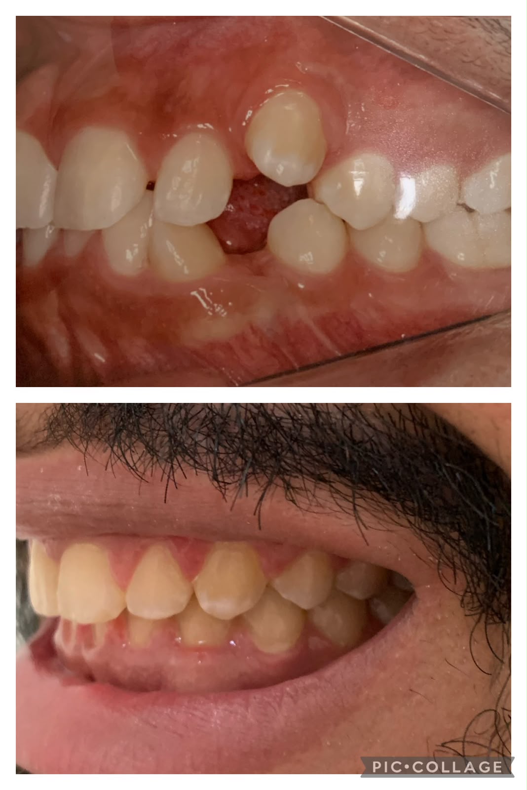 Antes e depois da ortodontia, foto 1