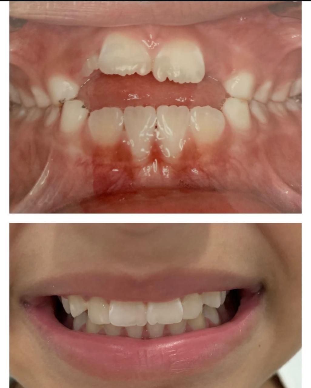 Antes e depois da ortodontia, foto 2